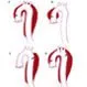 Aortic Dissection
