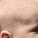 Picture of Cradle Cap