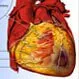 Heart Disease (Coronary Artery Disease)