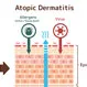Atopic Dermatitis vs. Psoriasis