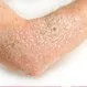 Types of Psoriasis: Medical Pictures and Treatments