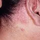 Picture of Psoriasis of the Scalp