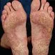 Picture of Psoriasis Vulgaris Soles