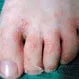 Picture of Ringworm Tinea Pedis