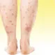 Skin Disease Picture Quiz - Identify These Common Skin Conditions