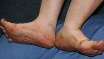 Diabetes Foot Problems 