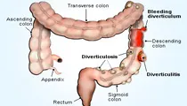 Diverticulitis